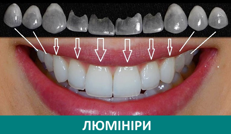 Установка люминиров в ТОП1 клинике Москвы - Немецкий имплантологический центр