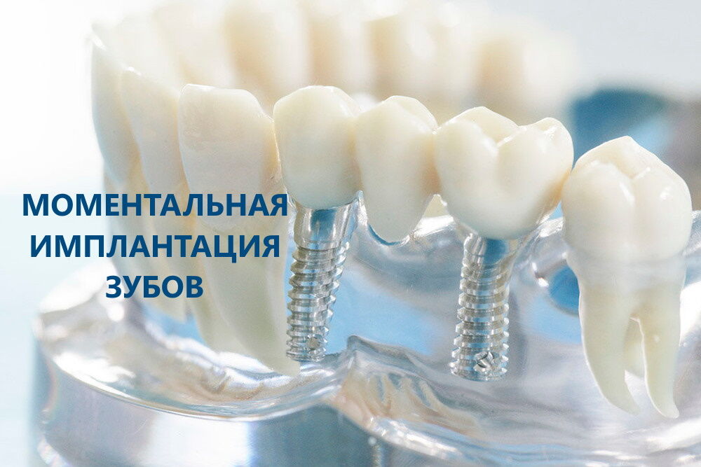 Миттєва шьплантація зубів