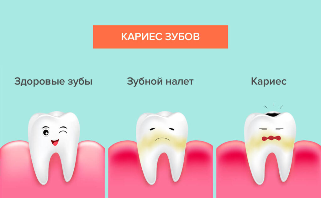 Карієс зубів. Як лікувати і чи можна уникнути?