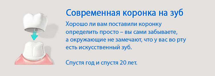 Яку коронку обрати?