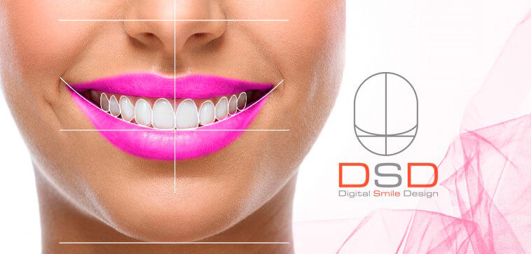 Цифровий дизайн усмішки — процедура DSD