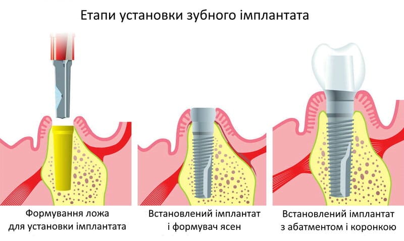 Імплантація