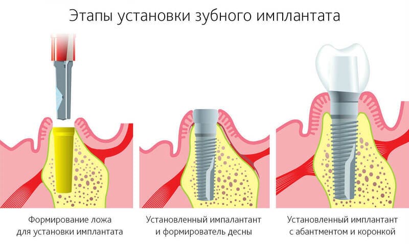 Имплантация